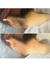 トリプルワン(111)/うなじ脱毛