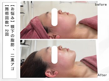 レッド(RED)/ダウンタイム無しの即効小顔