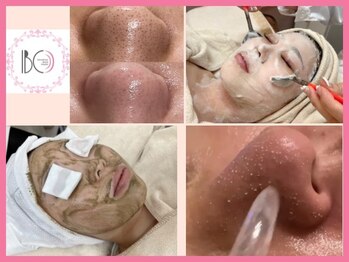 トータルサロンアイビーシー(トータルサロンIBC)の写真/毛穴と言えばIBC☆剥離して速効赤ちゃん肌ならハーブピーリング。剥離無しララピール等お客様に合せご提案
