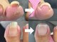 爪のいろはの写真/【巻き爪補正】放置したままでは変わらない、巻き爪や深爪など爪トラブルはプロにお任せください♪[フット]