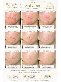 ソルカナ(Solkana)/9回後の症例写真