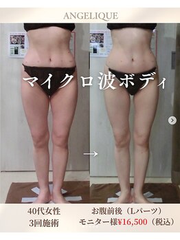 アンジェリークの写真/今一番選ばれているマイクロ波をつかった痩身で徹底ケア