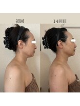 リーブル(LIBRE)/小顔コルギ　１年での変化