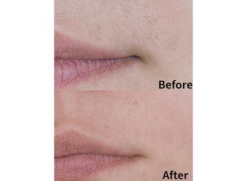 モンロー(MonroE+)/脱毛