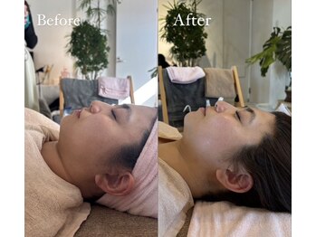 アスティオン(Astion)/Before After