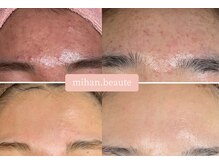 ミハン ボーテ(mihan.beaute)の雰囲気（【繰り返大人すニキビ】肌質改善ハーブピーリング　before/after）
