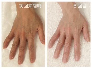 キレイテ 上野店/50代/6回目【上野ハンドケア】