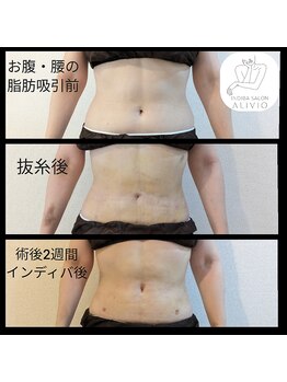 アリビオ(ALIVIO)/美容施術インディバモニター