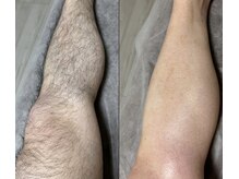 アンドエス 六本木(and S.)/足ワックス＋光のW脱毛≪脱毛≫