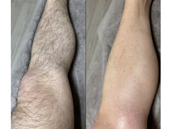 アンドエス 六本木(and S.)/足ワックス+光のW脱毛≪脱毛≫