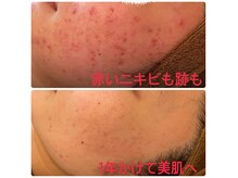 ポアレ(POARE)の雰囲気（長年の肌荒れも本気ケアで変われる！変わらない人はいない…）