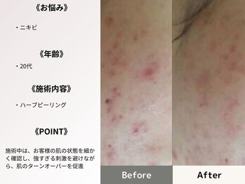 ルディラ 渋谷店/ハーブピーリング