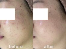 ホワイトアクア 鹿児島店(WHITE AQUA)/ハーブピーリング3ヶ月/肌質改善