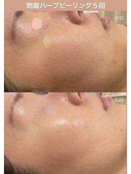 ハーブのほし/毛穴レス&きめ細やかな美白肌に!