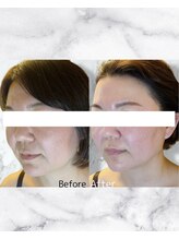 ルミライ(Lumirai)/たるみ改善|毛穴|フェイシャル