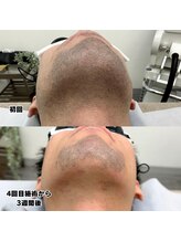 ビビ(BB)/ヒゲ脱毛4回目のお客様