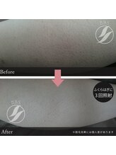 ティエラ(tierra)/レディース足脱毛