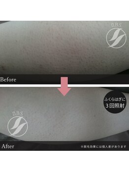 ティエラ(tierra)/レディース足脱毛