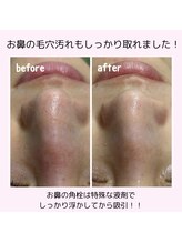 クラリ(Clari)/ハイドラ/毛穴洗浄/毛穴ケア