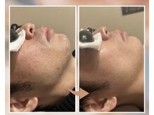 プルベル 平尾(Plus Belle)/ヒゲ脱毛