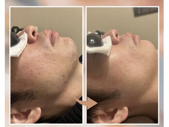 プルベル 平尾(Plus Belle)/ヒゲ脱毛