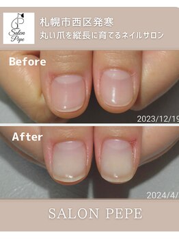 自爪育成で育てた親指