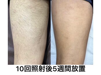 リル(RILU)/脚【脱毛】男性(before・after)