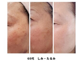 キキラ(kikila)/症例：しみ