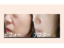サロンドミジュ(Salon de 美jyu)/最高品質ヒト幹細胞培養液導入