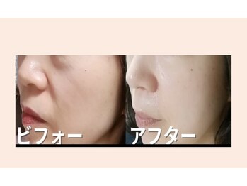 サロンドミジュ(Salon de 美jyu)/最高品質ヒト幹細胞培養液導入