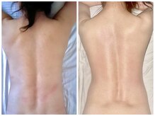 キラリ(Kirari)/高炭酸痩身マッサージ1回の施術