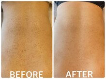 ハーブピーリング 恵比寿/毛孔性 苔癬