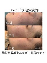 サラ/ハイドラ毛穴洗浄