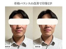 リン 吉祥寺店(Rin)/小顔矯正ビフォーアフター