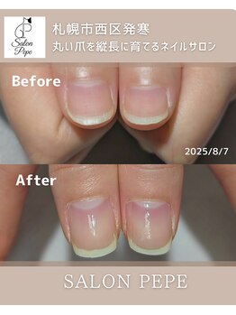 自爪育成で育てた親指