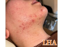 ベルフィオーレ(bel fiore)/20代女性　ララピール　Before