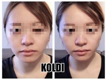 コルディ(KOLDI)/ヘッドスパ顔コルギ