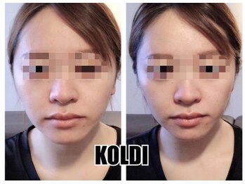 コルディ(KOLDI)/ヘッドスパ顔コルギ