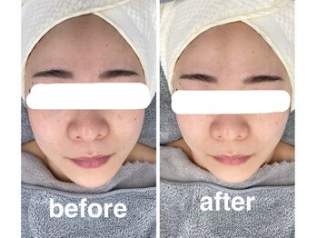 ハロ 南青山(HALO)/全顔三層打ち☆小顔Vリフト