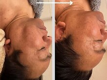 エムエー(MA)/日本初3種幹細胞・リフトアップ