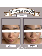 ビーマジック(美magic)/サーマトリックス