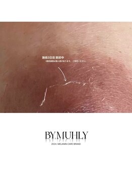 モア(more.)/乳輪のダウンタイム皮むけ