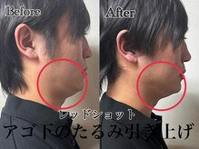アンドエス 六本木(and S.)/アゴ下のたるみ肉にアプローチ！
