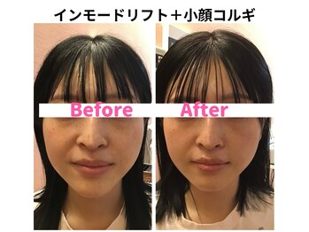 サロン ド シャーロット 恵比寿/＃恵比寿小顔＃インモードリフト