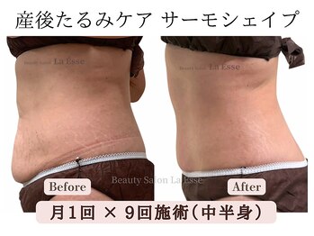 ラエッセ(La Esse)/妊娠線もキュッとつるんと♪