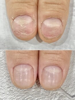 リファーレ(RIFARE)/【深爪矯正】凸凹爪が劇的変化!