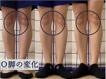 ひかわ整骨院 熊本巻き爪センター/Ｏ脚矯正 ビフォーアフター