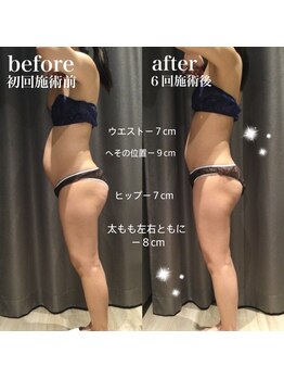 アイスタイル(i-style)/脂肪冷却/痩身ダイエット/泉大津