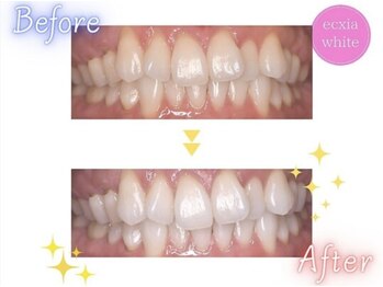エクシアホワイトニング 静岡駅前店/ホワイトニングビフォーアフター