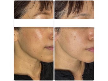 シャムリー(SHAMRY)/グルタチオン6%